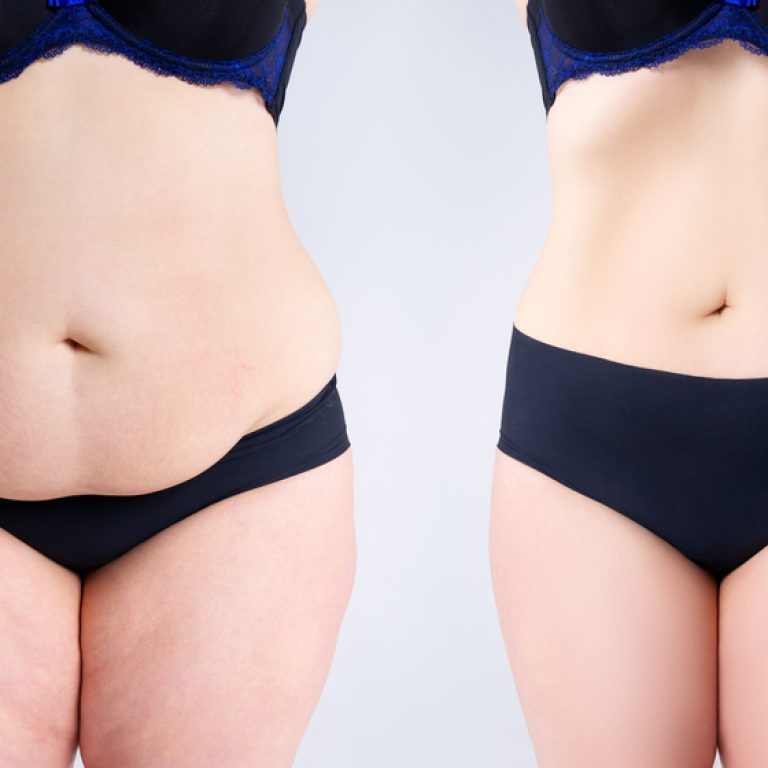 Best Tummy Tuck Specialist in Virginia