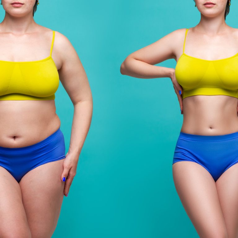 Improve Your Liposuction Results Near Fairfax