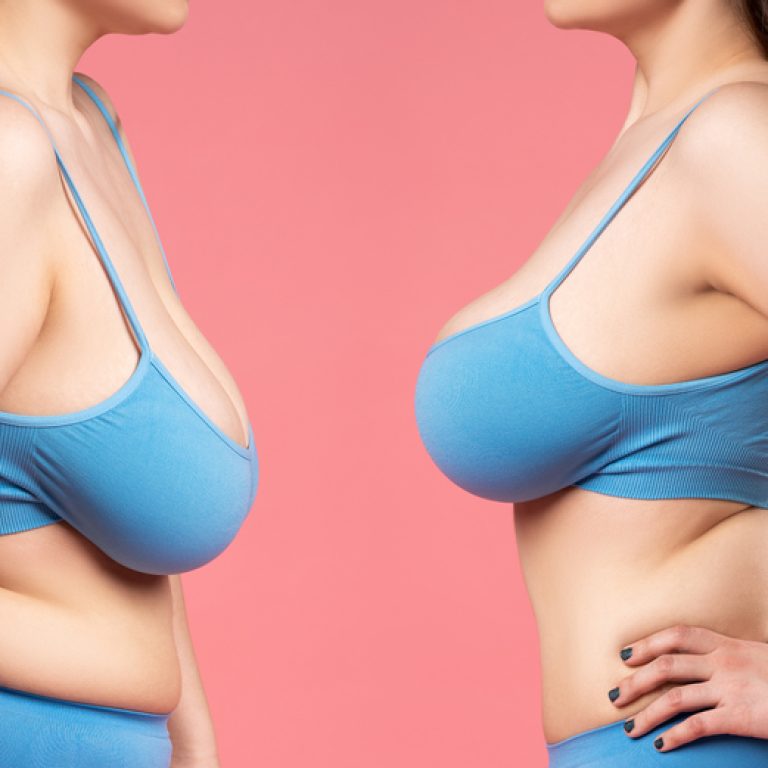 Breast Lift Specialist