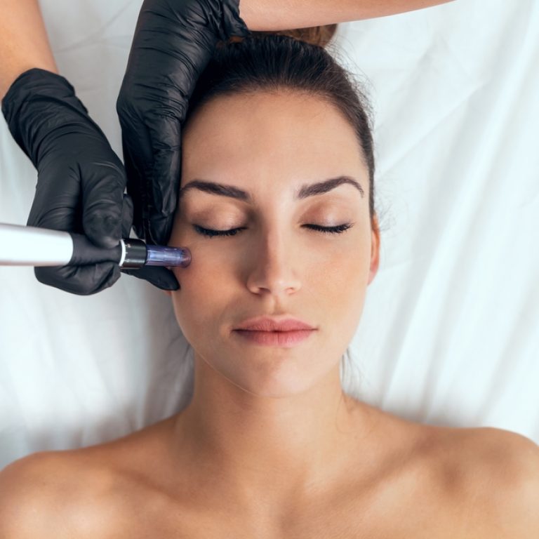 PRP with Microneedling