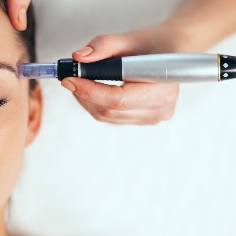How Long Does Microneedling Last?