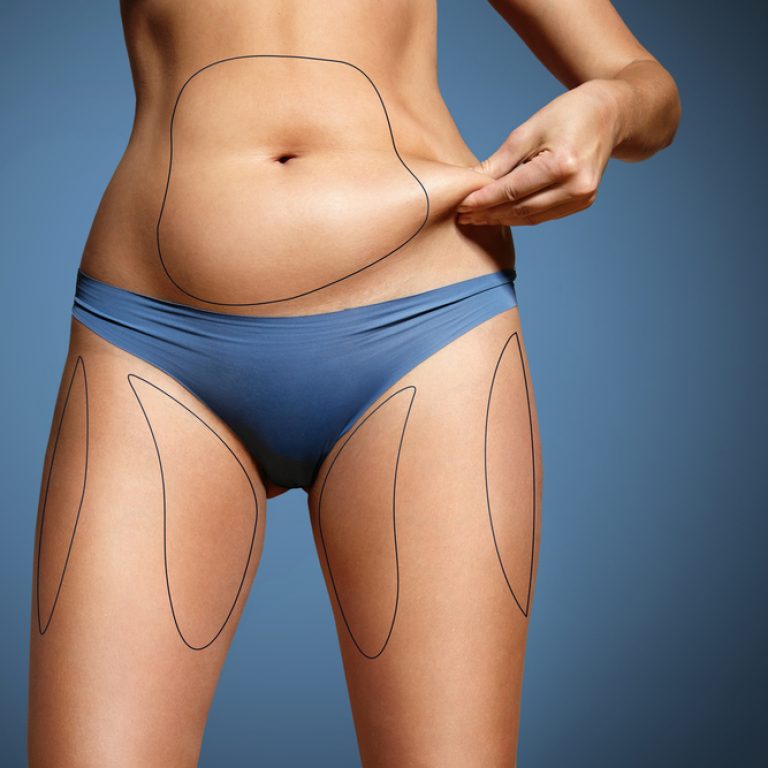 Liposuction Specialists