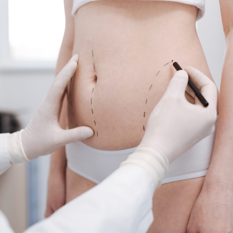 Liposuction Specialist